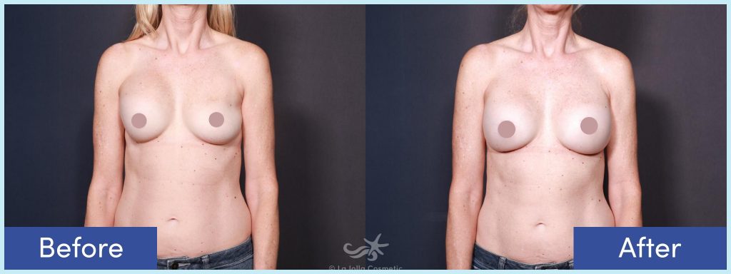 Breast implant removal before and after photos