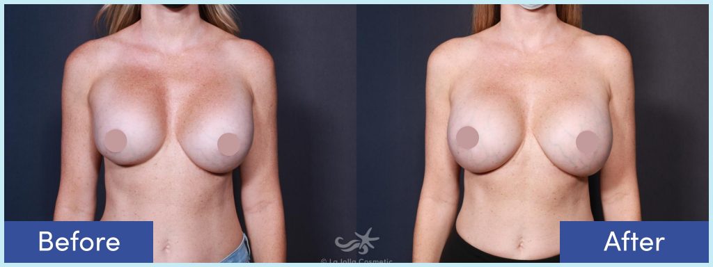 Breast implant removal before and after photos