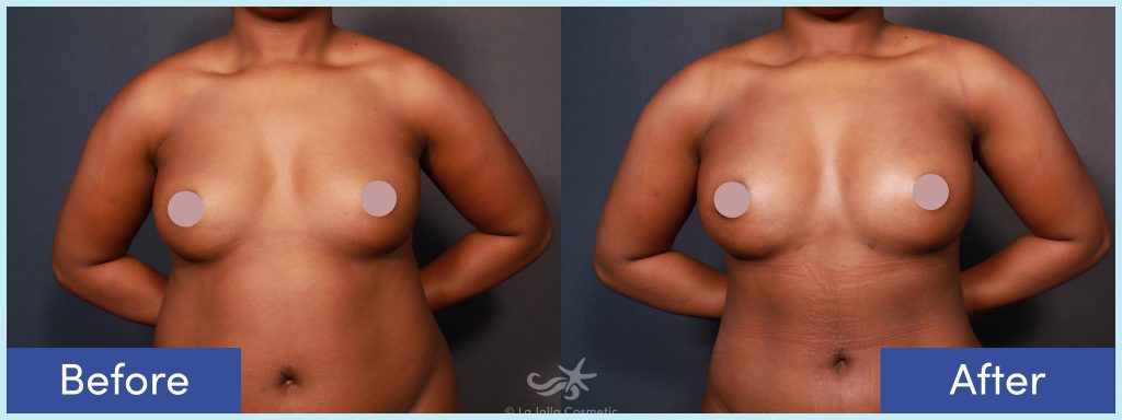 Liposuction and fat transfer to breasts before and after photo