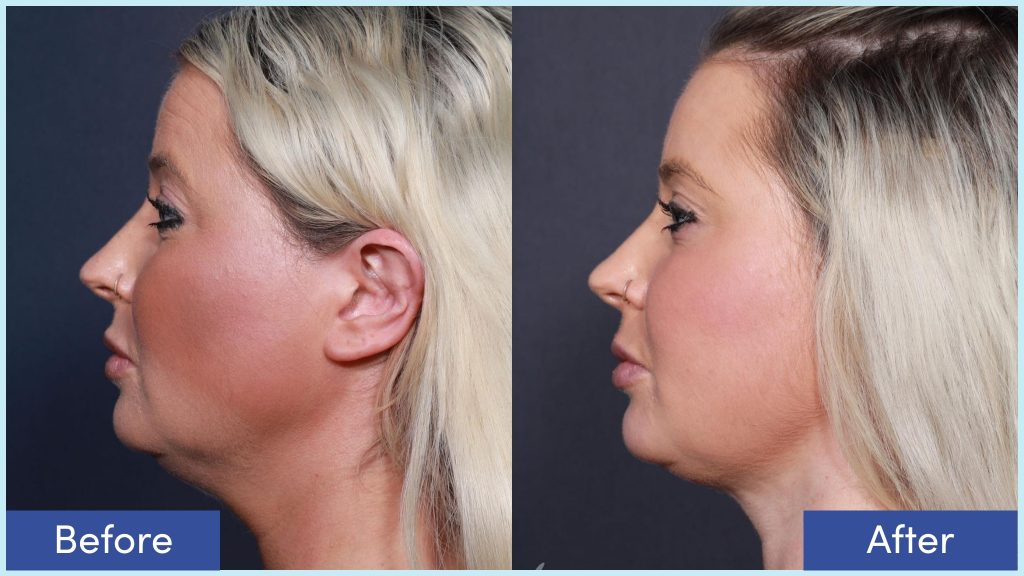 Chin liposuction before and after