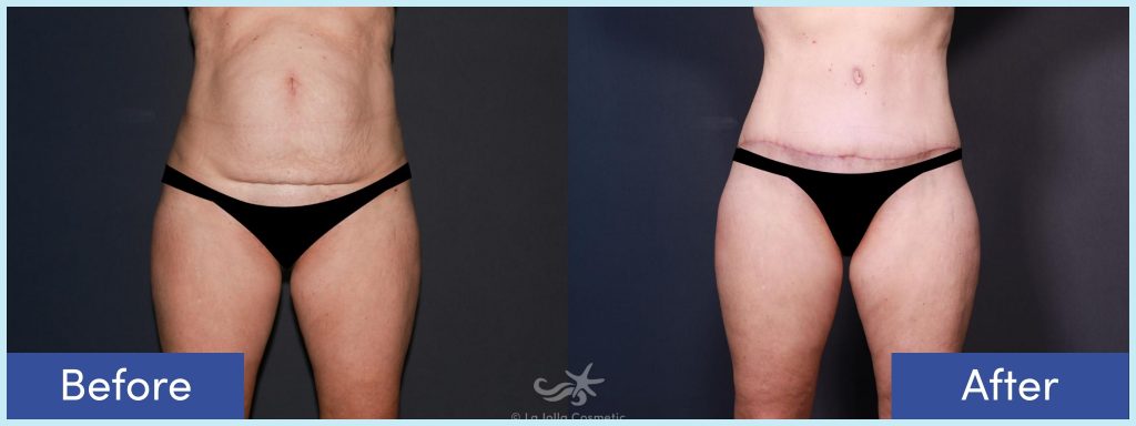 Liposuction and tummy tuck before and after photo