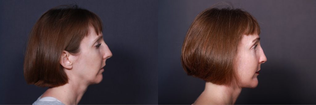 Side-by-side photos of Kathleen’s face and neck from the side before & after LJC procedures