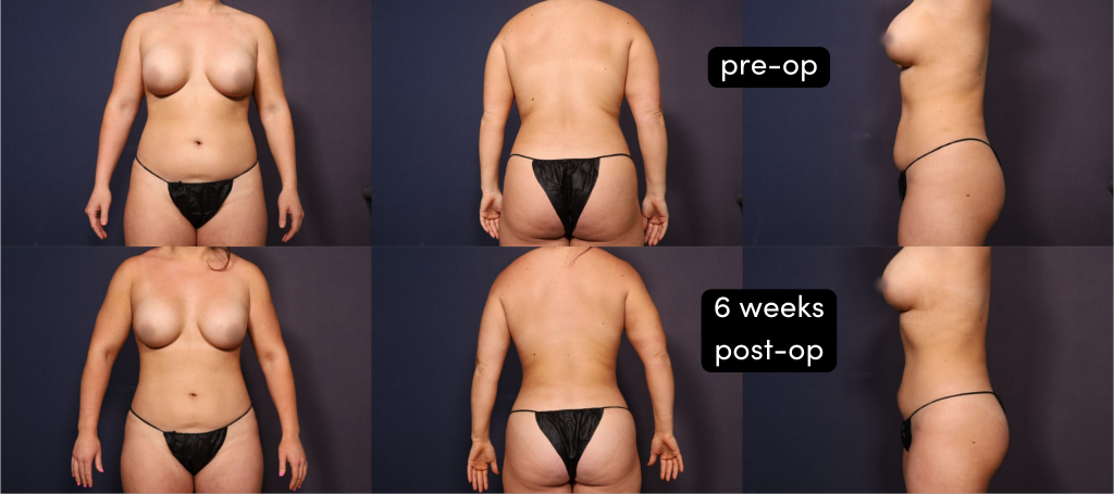 Photos of the front, back, and side of Taylor before surgery (top row) and 6 weeks after 360 lipo and Renuvion (bottom row)
