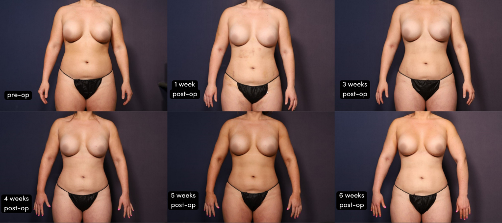 6 progression photos of Taylor's body from pre-op to 6 weeks after 360 lipo and Renuvion