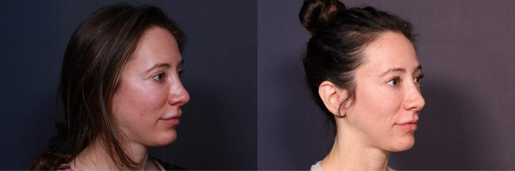 Diagonal view of Maria before (left) vs after (right) Ultherapy and HALO laser