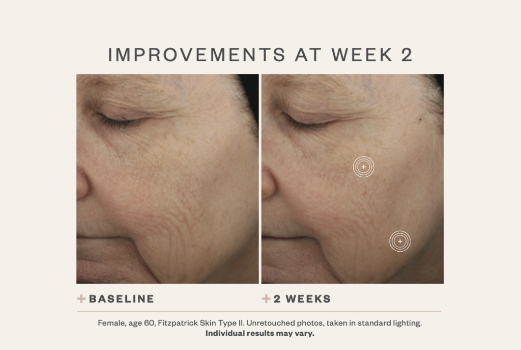 SkinMedica TNS Advanced+ Serum before and after 2