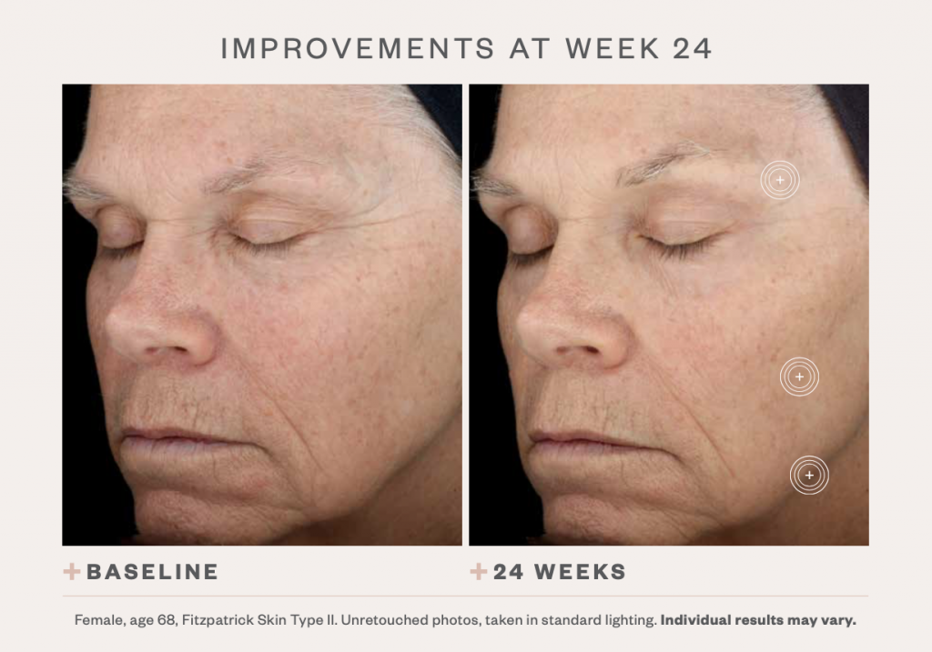 SkinMedica TNS Advanced+ Serum before and after 1