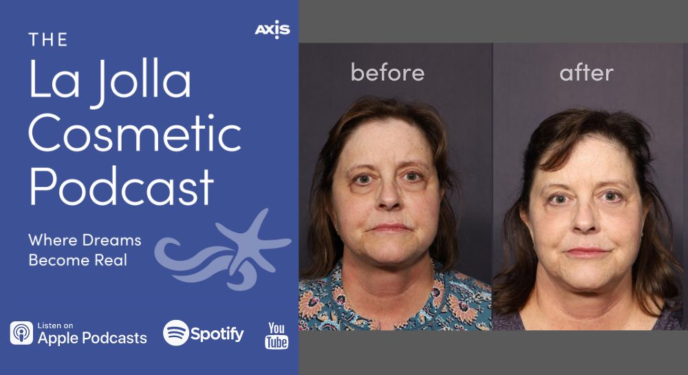 [The La Jolla Cosmetic Podcast | Where Dreams Become Real] A patient before (left) and after (right) facial rejuvenation surgery