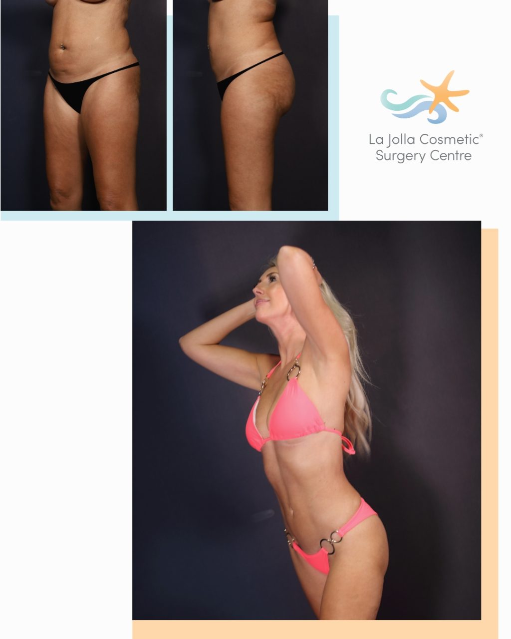 Amie's front and left side before (left) and after (right) 360 lipo