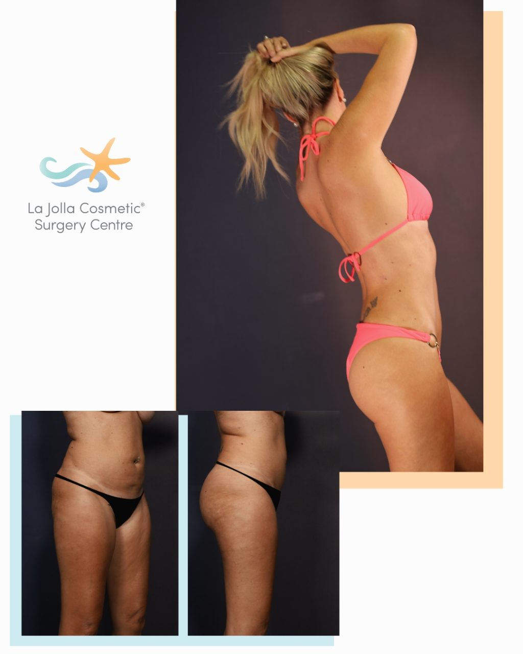 Amie's back and right side before (left) and after (right) 360 lipo