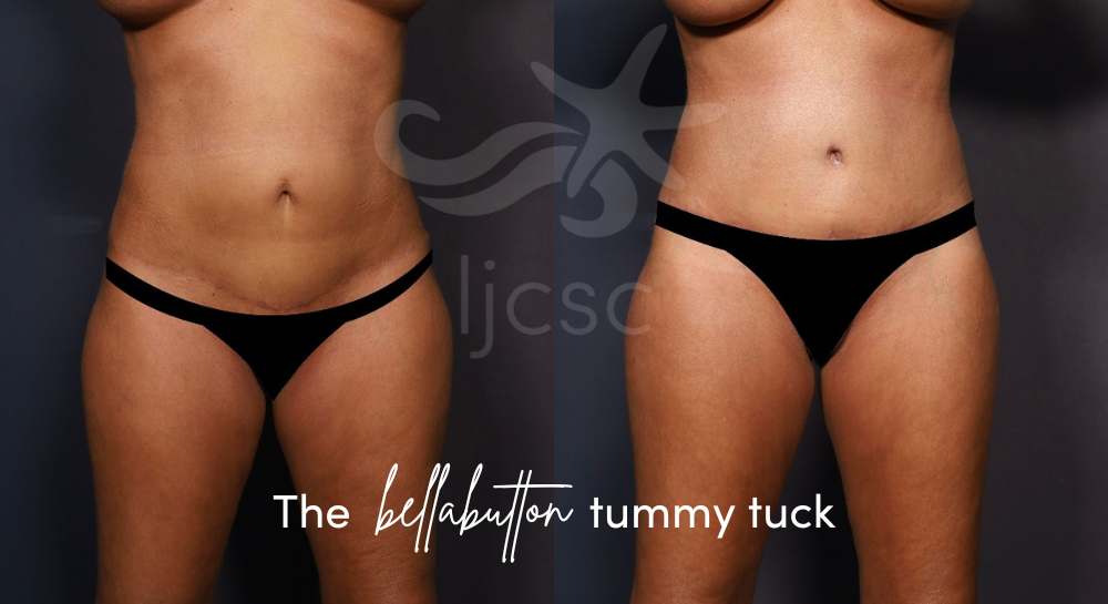 {The BellaButton tummy tuck by Hector Salazar, MD, FACS] before and after photo side by side