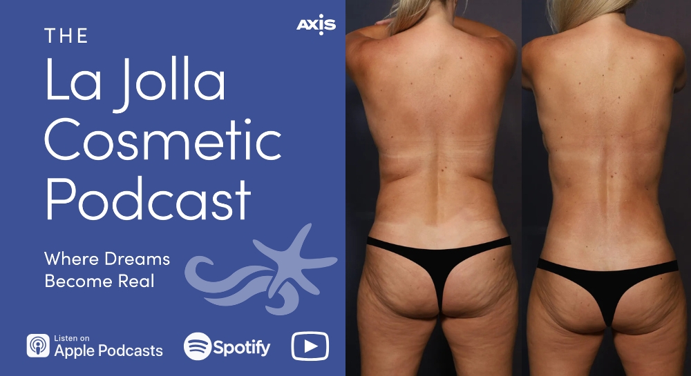 [The La Jolla Cosmetic Podcast cover art] Patient Amy before (left) and after (right) 360 lipo with Dr. Luke Swistun