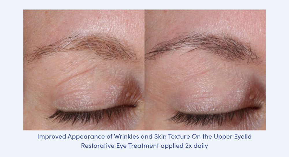 Closeup of eyelids that have used Alastin Restorative Eye Treatment