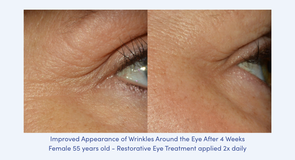 Before and after closeup of Alastin Restorative Eye Treatment