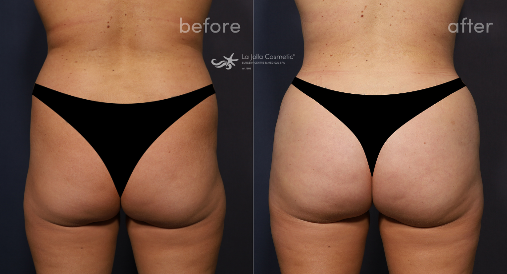 Kaylie before her skinny BBL with Dr. Brahme (left) and 4 weeks after her skinny BBL with Dr. Brahme (right)