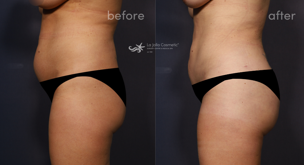 Kaylie before her skinny BBL with Dr. Brahme (left) and 4 weeks after her skinny BBL with Dr. Brahme (right)