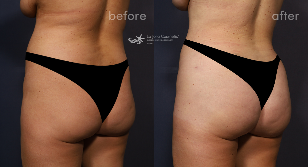 Kaylie before her skinny BBL with Dr. Brahme (left) and 4 weeks after her skinny BBL with Dr. Brahme (right)