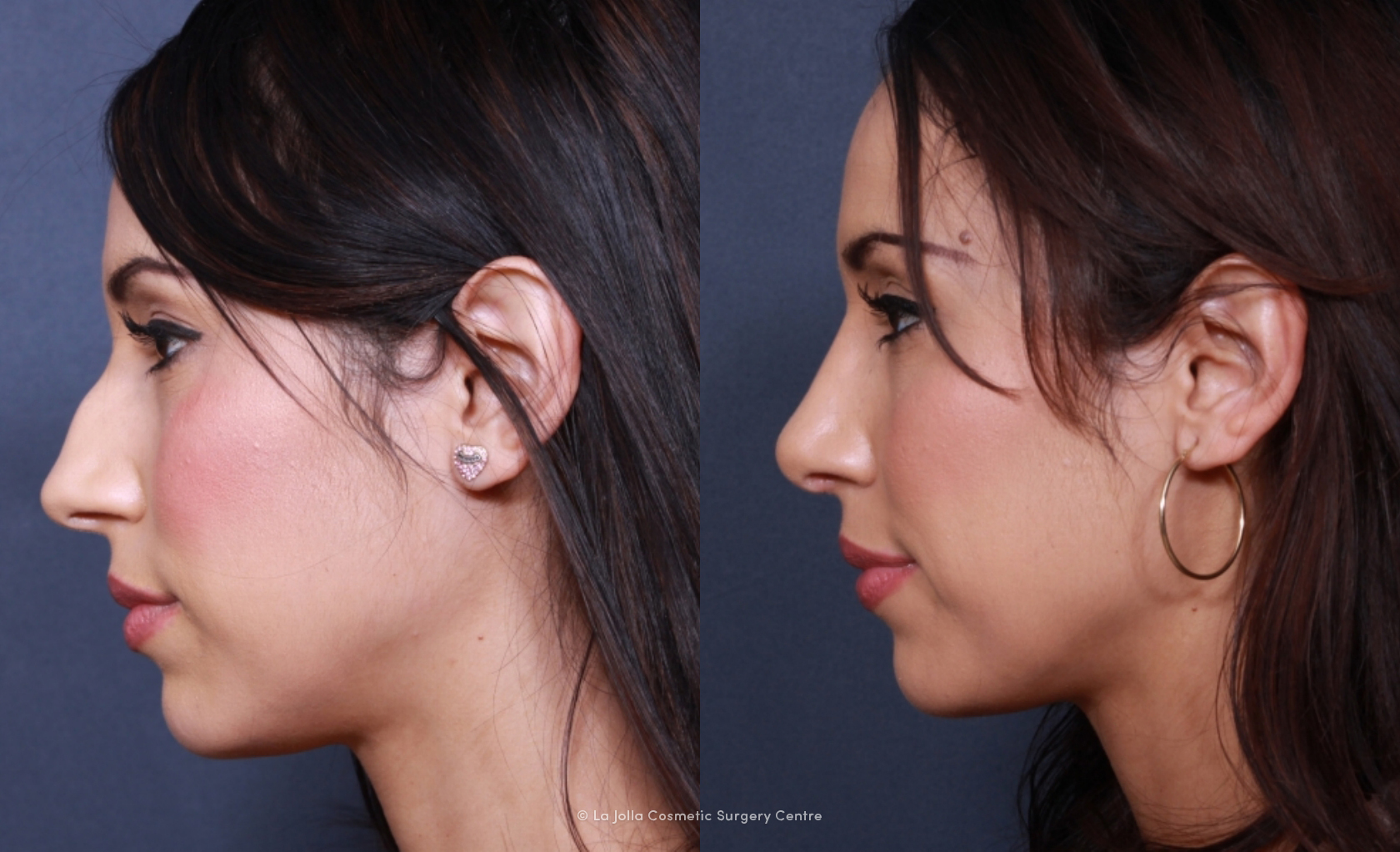 A real LJCSC rhinoplasty patient of Dr. Brahme's.