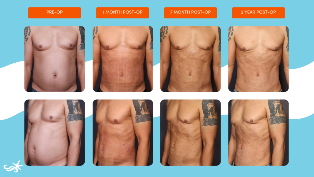 Before-and-after photo series showing a male patient’s chest and abdomen from front and side views at four stages: pre-op, 1 month post-op, 7 months post-op, and 2 years post-op, demonstrating progressive healing and contour improvement after surgery.