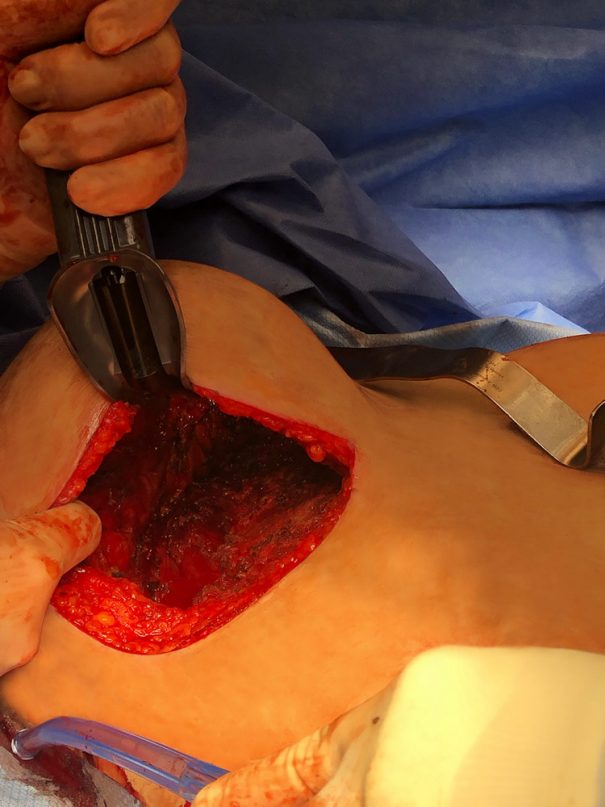 The breast pocket following implant removal.
