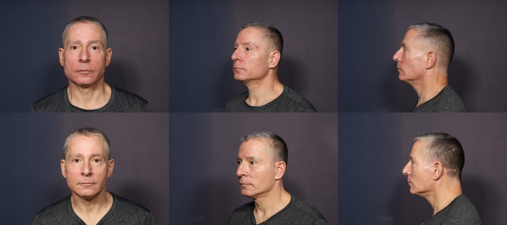 Eric before (top) vs 4 months after his neck lift with fat transfer by Dr. Brahme (bottom)