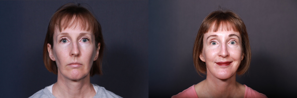 Side-by-side photos of the front of Kathleen’s face and neck from the side before & after LJCSC procedures