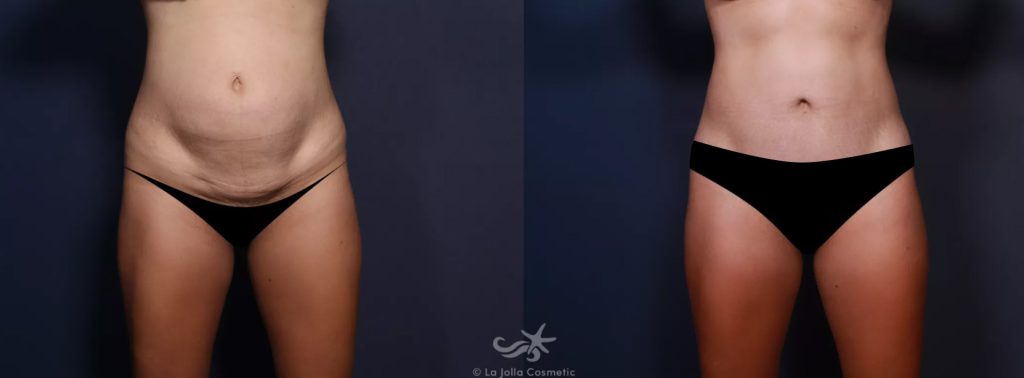BellaButton tummy tuck belly button before and after