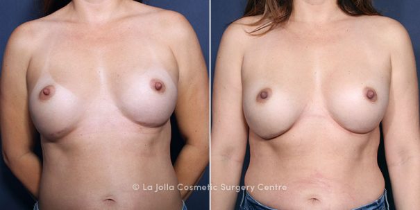 Before & after breast implant revision surgery using GalaFLEX to repair the right inframammary fold.