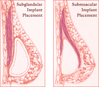 Medical illustration comparing subglandular implant placement on the left and submuscular implant placement on the right, showing anatomical differences in breast augmentation techniques.