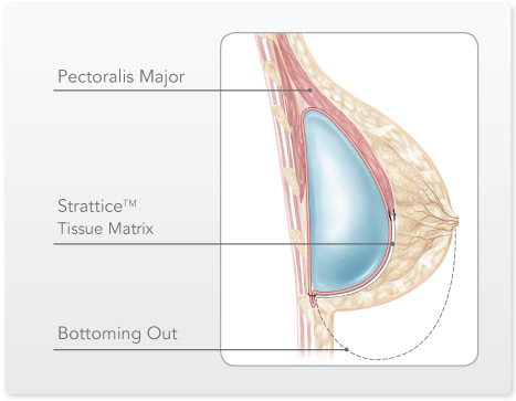 illustration-bottoming-out-2