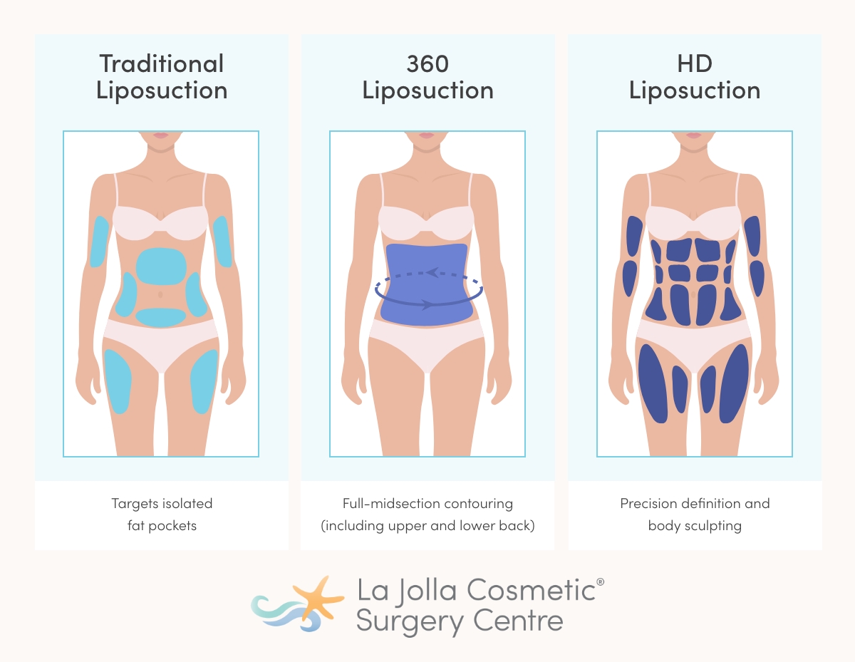 Diagram comparing traditional liposuction, 360 Lipo, and HD Lipo treatment areas by La Jolla Cosmetic Surgery Centre in San Diego.