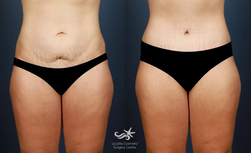 a tummy tuck before (left) and after (right) result by Dr. Hector Salazar