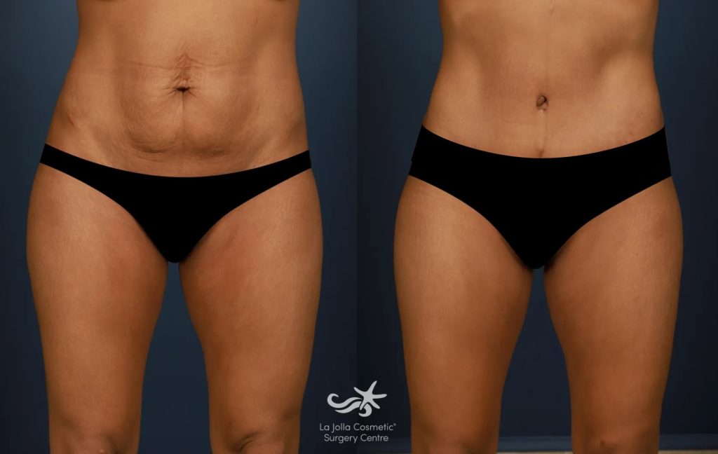 a tummy tuck before (left) and after (right) result by Dr. Hector Salazar