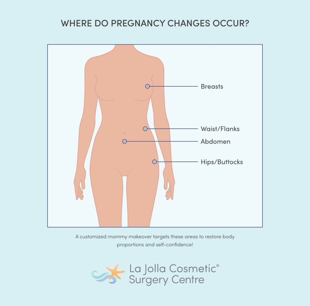 Diagram showing common areas addressed in a mommy makeover, including the breasts, abdomen, waist/flanks, and hips/buttocks.