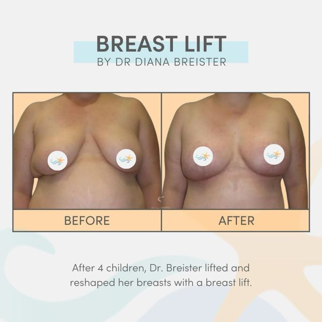 Dr. Breister is restoring youthful contours left and right, but this #mommymakeover result in particular deserves some limelight. 👏✨ 

After 4 children, this patient decided to invest in herself with a mommy makeover. Dr. Breister lifted and reshaped her breasts with a breast lift and tightened her midsection with a tummy tuck. 🌟

#beforeandafter #breastlift #sandiegoplasticsurgeon #bestofsandiego