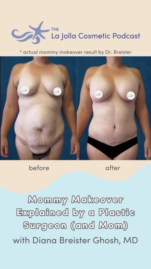 Yes, motherhood is beautiful. But bringing children into the world wreaks some havoc on the body! Luckily, we have mommy makeover to bounce us back. 💛✨

On our latest podcast episode, plastic surgeon (and mom) Dr. Breister shares what body restoration procedures mommy makeover typically consists of and the advantages of combining them into one surgery. Link in bio.🎙️🙌

#podcast #mommymakeover #breastaugmentation #breastlift #tummytuck #liposuction #breastsurgery #motherhood #plasticsurgery #plasticsurgeon #labiaplasty #sandiegoplasticsurgery #sandiegoplasticsurgeon