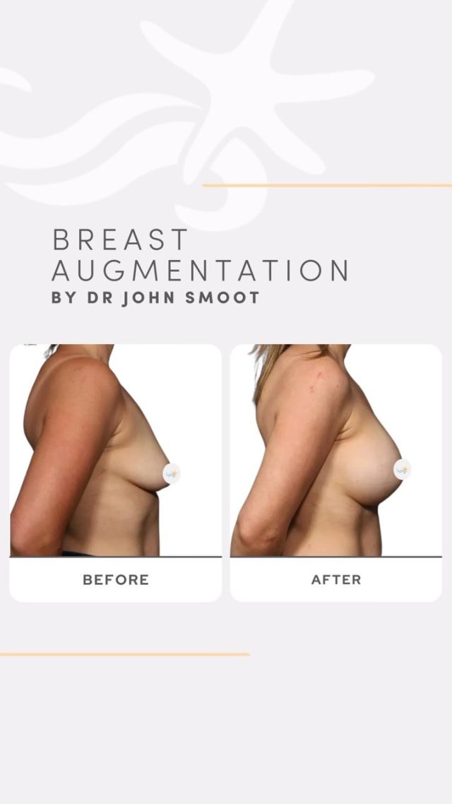 When your natural breast size just isn’t enough for you, Dr. Smoot knows just what to do! 🙌🌟 This patient is thrilled with her newly enhanced bust after a breast augmentation with our veteran breast surgeon. ❤️

#breastaugmentation #sandiegoplasticsurgery #bestofsandiego #beforeandafter #selfcare