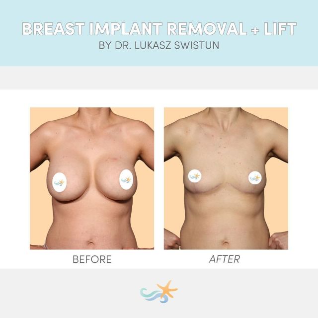 This patient decided breast implants no longer suited her. Dr. Swistun helped her part ways and confidently enter a whole new phase. 💓✨👏 #explant #breastimplantremoval
 
💡🗓️ Interested in saying goodbye to your breast implants? Join Dr. Swistun Wednesday, March 6 for our live event on all things breast implant removal & recovery!

#breastimplantexplant #breastimplantsillness #explant