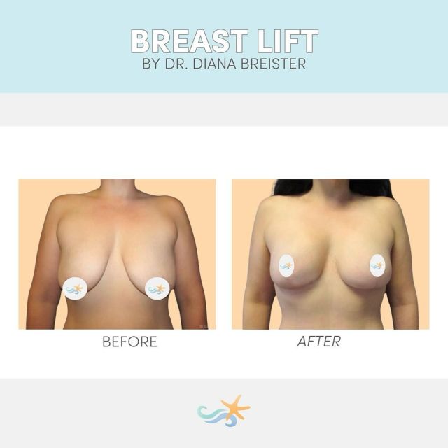 Thanks to Dr. Breister, this patient looks like she’s wearing a push-up bra 24/7 and she’s living for it. 😍 Breast lift results always make our jaws hit the floor! 👏🌟

#beforeandafterbreastreductionsurgery #sandiegoplasticsurgeon #femaleplasticsurgeon #bestofsandiego