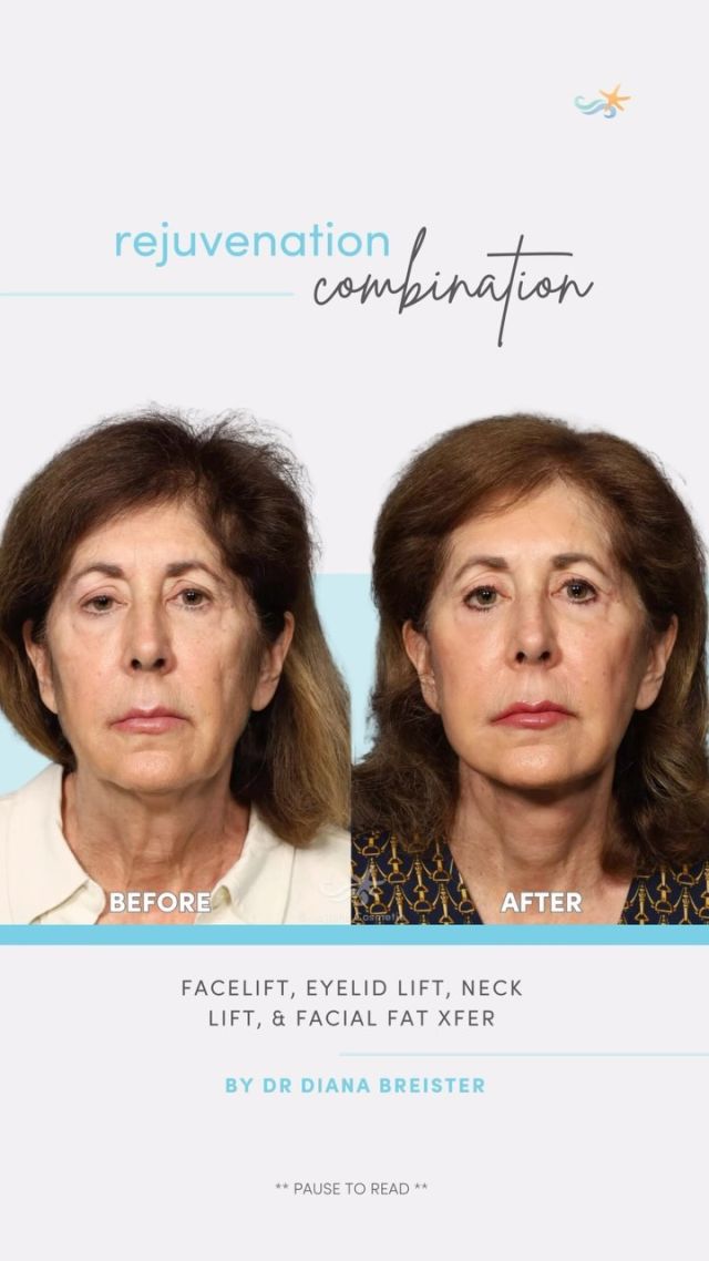 This beauty is feeling refreshed and as confident as she did decades ago after full facial rejuvenation with Dr. Breister! From brighter eyes to a defined jawline, she can’t help but shine. 🌟🙌

👩‍⚕️ Doctor: Diana Breister Ghosh, MD

🩹 Procedures: Facelift, Eyelid Lift, Neck Lift, Facial Fat Transfer

👤 Age: 71 years old

#beforeandafterfacelift #selfcare #sandiegoplasticsurgeon #bestofsandiego