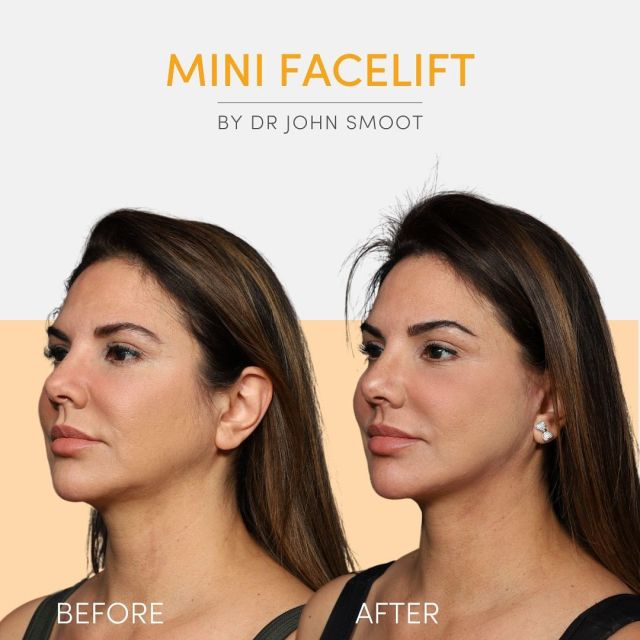 Sometimes all you need is a little boost to make all the difference! 🌟🙌 

She is feeling and looking a decade younger after a mini facelift with Dr. Smoot. 💛

#minifaceliftsurgery #sandiegoplasticsurgeon #beforeandafterplasticsurgery #bestofsandiego #plasticsurgerybeforeandafter #faceliftsurgery