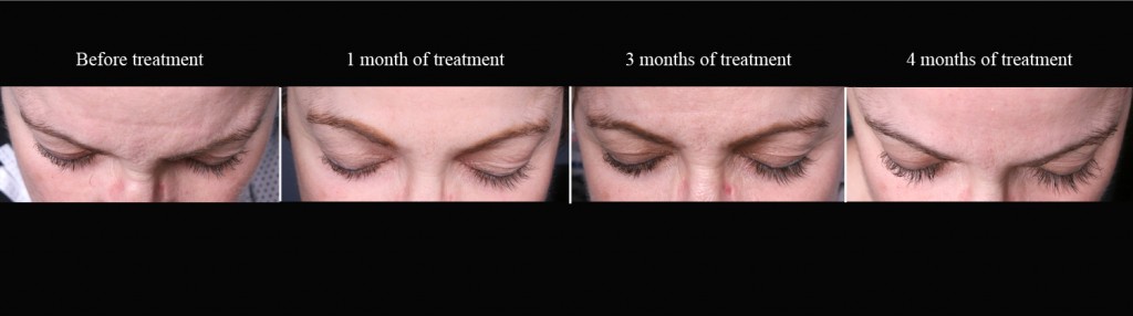 latisse before and after photos