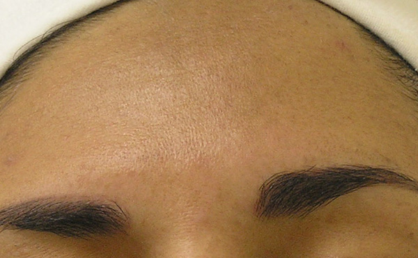 san diego hydrafacial md Sun_Damage_Acne_After_4_Treatments