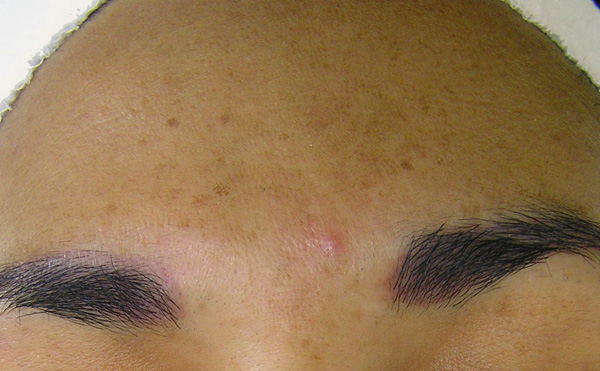 san diego hydrafacial md Sun_Damage_Acne_Before-600