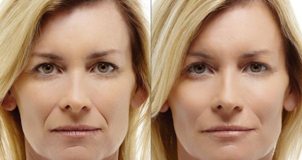 radiesse-before-after