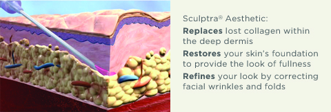 sculptra-cross how does sculptra work