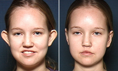 Otoplasty Surgery Cost Pin My Ears Back Pinning Your Ears Back 2025