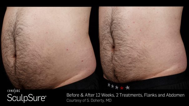 SculpSure before and after images SculpSure before and after images