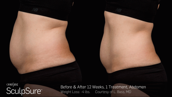 SculpSure fat reduction San Diego