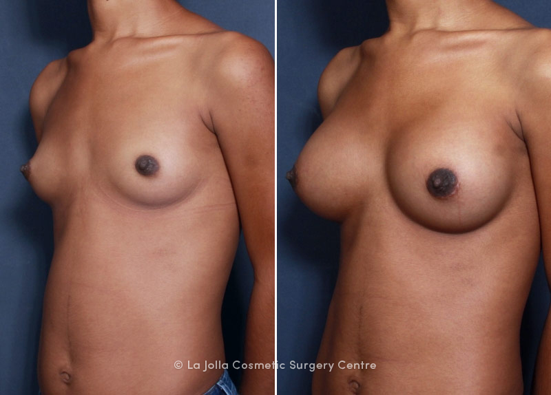 Augmentation breast jolla la surgery